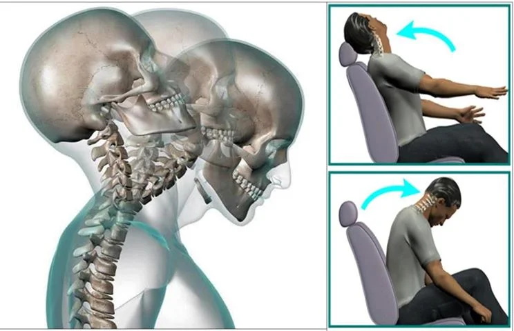 Secuelas del latigazo cervical: Asesoría legal para tu bienestar