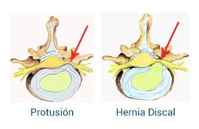 Diferencias legales entre hernia y protrusión: ¿cuál es más compleja?