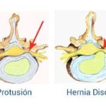 Diferencias legales entre hernia y protrusión: ¿cuál es más compleja?